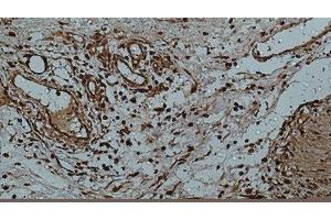 Immunohistochemistry of paraffin-embedded Human colon using Galectin 3 Monoclonal Antibody at dilution of 1:50. (Galectin 3 antibody)