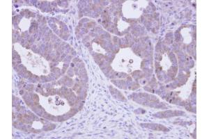 IHC-P Image Immunohistochemical analysis of paraffin-embedded NCIN87 xenograft, using TCP-1 epsilon, antibody at 1:500 dilution. (CCT5 antibody)