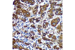 Immunohistochemistry of paraffin-embedded Human liver cancer using CTNN Rabbit pAb (ABIN7266136) at dilution of 1:100 (40x lens). (CTNNA3 antibody  (AA 1-240))