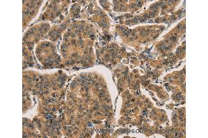 Immunohistochemistry of Human thyroid cancer using CTNNBIP1 Polyclonal Antibody at dilution of 1:30