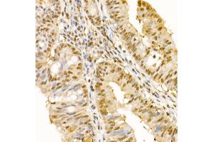 Immunohistochemistry of paraffin-embedded human colon carcinoma using SS18 Rabbit pAb (ABIN6133185, ABIN6148473, ABIN6148474 and ABIN6222754) at dilution of 1:100 (40x lens). (SS18 antibody  (AA 1-240))