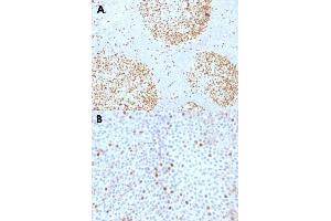 Immunohistochemical staining (Formalin-fixed paraffin-embedded sections) of human tonsil (A) and human bladder carcinoma (B) with TOP2A monoclonal antibody, clone TOP2A/1361 .