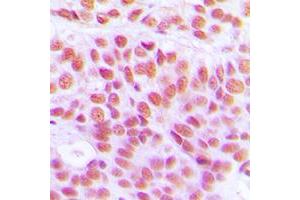 Immunohistochemical analysis of Histone H4 (AcK12) staining in human breast cancer formalin fixed paraffin embedded tissue section.
