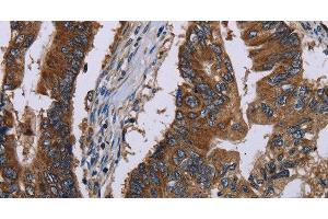 Immunohistochemistry of paraffin-embedded Human colon cancer tissue using CLDND1 Polyclonal Antibody at dilution 1:40 (CLDND1 antibody)
