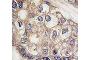 IHC analysis of FFPE human hepatocarcinoma tissue stained with AFP antibody (alpha Fetoprotein antibody  (AA 300-329))