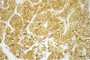 Immunohistochemistry was performed on paraffin-embedded human hepatocarcinoma using Glutamate-ammonia ligase antibody (ABIN7798741), 1:200). (Recombinant GLUL antibody)