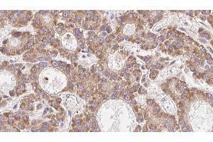ABIN6279253 at 1/100 staining Human liver cancer tissue by IHC-P.