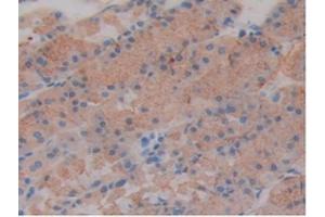 IHC-P analysis of Mouse Stomach Cancer Tissue, with DAB staining. (SLIT1 antibody  (AA 603-773))
