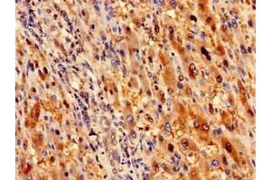 Immunohistochemistry analysis of human liver cancer using ABIN7168095 at dilution of 1:100 (Ribokinase antibody  (AA 2-322))