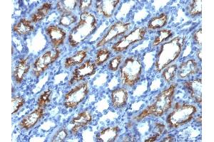Formalin-fixed, paraffin-embedded human Renal Cell Carcinoma stained with Interferon gamma Mouse Monoclonal Antibody (IFNG/466). (Interferon gamma antibody)