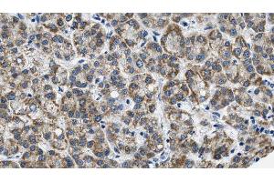 ABIN6269004 at 1/100 staining Human liver cancer tissue by IHC-P. (Metabotropic Glutamate Receptor 3 antibody  (C-Term))