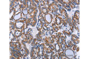 Immunohistochemistry of Human lung cancer using INTS10 Polyclonal Antibody at dilution of 1:50 (INTS10 antibody)