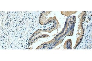 Immunohistochemistry of paraffin-embedded Human prost ate cancer tissue using FCRLA Polyclonal Antibody at dilution of 1:90(x200)