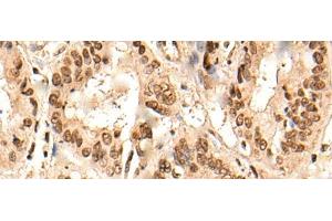 Immunohistochemistry of paraffin-embedded Human liver cancer tissue using URI1 Polyclonal Antibody at dilution of 1:45(x200) (URI1 antibody)