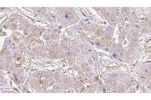 ABIN6272716 at 1/100 staining Human liver cancer tissue by IHC-P. (OR1K1 antibody)