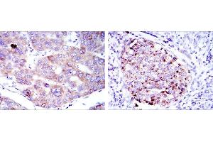Immunohistochemical analysis of paraffin-embedded liver cancer tissues (left) and kidney cancer tissues (right) using EEF2 mouse mAb with DAB staining. (EEF2 antibody)