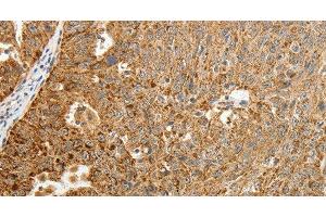 Immunohistochemistry of paraffin-embedded Human ovarian cancer tissue using TFF2 Polyclonal Antibody at dilution 1:40 (Trefoil Factor 2 antibody)