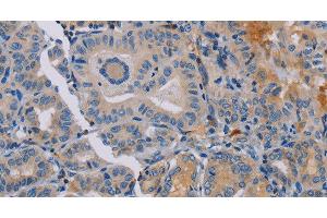 Immunohistochemistry of paraffin-embedded Human thyroid cancer tissue using PYY Polyclonal Antibody at dilution 1:30 (Peptide YY antibody)