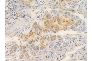 ABIN6261413 and ABIN6266532 at 1/100 staining human lung squamous cell carcinoma by IHC-P. (E2F6 antibody  (Internal Region))