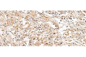 Immunohistochemistry of paraffin-embedded Human liver cancer tissue using FGR Polyclonal Antibody at dilution of 1:35(x200) (Fgr antibody)