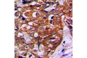 Immunohistochemical analysis of MVK staining in human breast cancer formalin fixed paraffin embedded tissue section. (MVK antibody)
