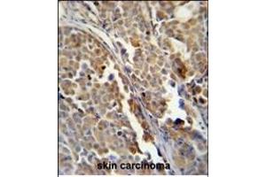ALDH3A2 Monoclonal Antibody (Ascites) ABIN659009 immunohistochemistry analysis in formalin fixed and paraffin embedded human skin carcinoma followed by peroxidase conjμgation of the secondary antibody and DAB staining. (ALDH3A2 antibody)