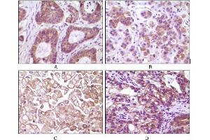 Immunohistochemical analysis of paraffin-embedded human colon carcinoma(A), breast carcinoma(B), kidney cell carcinoma(C), bladder carcinoma tumor(D), showing membrane and cytoplasmic localization using IKBKB mouse mAb with DAB staining.