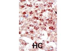 Formalin-fixed and paraffin-embedded human cancer tissue reacted with the primary antibody, which was peroxidase-conjugated to the secondary antibody, followed by DAB staining. (SUMO2/3 antibody  (C-Term))