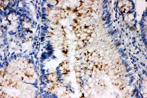 Anti-SSX2 antibody, IHC(P) IHC(P): Human Intestinal Cancer Tissue (SSX2 antibody  (C-Term))