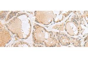 Immunohistochemistry of paraffin-embedded Human thyroid cancer tissue using CNPY3 Polyclonal Antibody at dilution of 1:55(x200) (TNRC5 antibody)