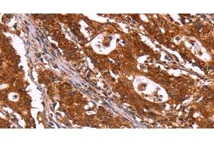 Immunohistochemistry of paraffin-embedded Human gastric cancer using ABI1 Polyclonal Antibody at dilution of 1:40 (ABI1 antibody)