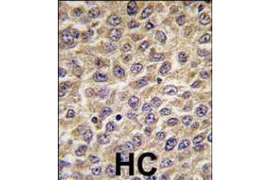 Formalin-fixed and paraffin-embedded human hepatocarcinoma tissue reacted with ILK Antibody (S246) , which was peroxidase-conjugated to the secondary antibody, followed by DAB staining. (ILK antibody  (AA 225-253))