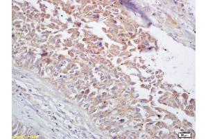 Formalin-fixed and paraffin embedded human lung carcinoma labeled with Rabbit Anti CYP5A1/Thromboxane synthase Polyclonal Antibody, Unconjugated (ABIN726080) at 1:200 followed by conjugation to the secondary antibody and DAB staining