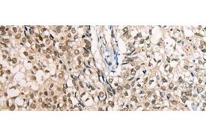 Immunohistochemistry of paraffin-embedded Human lung cancer tissue using CDT1 Polyclonal Antibody at dilution of 1:45(x200) (CDT1 antibody)