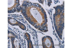 Immunohistochemistry of Human colon cancer using PCDHAC2 Polyclonal Antibody at dilution of 1:50
