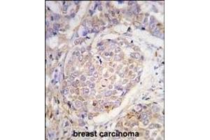 Forlin-fixed and paraffin-embedded hun breast carcino tissue reacted with GEA10 antibody (C-term) (ABIN390102 and ABIN2840614) , which was peroxidase-conjugated to the secondary antibody, followed by DAB staining. (MAGEA10 antibody  (C-Term))