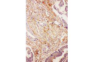 Anti-Diubiquitin antibody, IHC(P) IHC(P): Human Intestinal Cancer Tissue (UBD antibody  (N-Term))