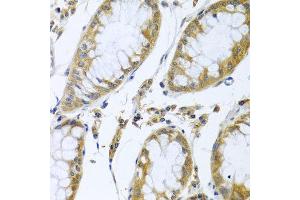 Immunohistochemistry of paraffin-embedded human colon carcinoma using FBXL5 antibody at dilution of 1:100 (x40 lens). (FBXL5 antibody)