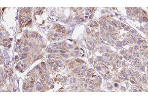 ABIN6276808 at 1/100 staining Human Melanoma tissue by IHC-P. (CCL4 antibody  (Internal Region))