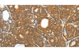 Immunohistochemistry of paraffin-embedded Human thyroid cancer using PRDX3 Polyclonal Antibody at dilution of 1:50 (Peroxiredoxin 3 antibody)