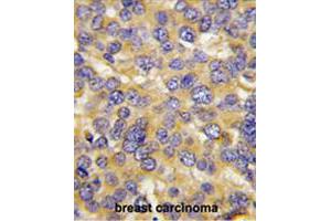 Formalin-fixed and paraffin-embedded human breast carcinoma tissue reacted with DKK3 polyclonal antibody  , which was peroxidase-conjugated to the secondary antibody, followed by DAB staining. (DKK3 antibody  (N-Term))