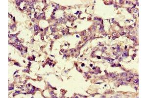 Immunohistochemistry of paraffin-embedded human gastric cancer using ABIN7159937 at dilution of 1:100