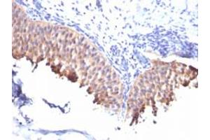 Immunohistochemical staining (Formalin-fixed paraffin-embedded sections) of human bladder carcinoma with KRT10 monoclonal antibody, clone SPM261 . (Keratin 10 antibody)