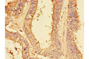 Immunohistochemistry of paraffin-embedded human endometrial cancer using ABIN7149414 at dilution of 1:100 (PLA2G4A antibody  (AA 379-533))