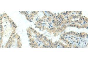 Immunohistochemistry of paraffin-embedded Human thyroid cancer tissue using NPVF Polyclonal Antibody at dilution of 1:80(x200) (NPVF antibody)