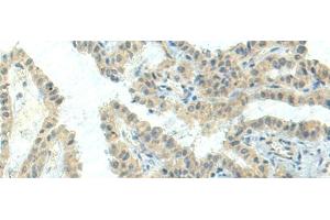 Immunohistochemistry of paraffin-embedded Human thyroid cancer tissue using NPVF Polyclonal Antibody at dilution of 1:80(x200)