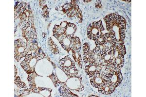 Anti-TJP2 antibody, IHC(P) IHC(P): Human Intestinal Cancer Tissue (TJP2 antibody  (C-Term))