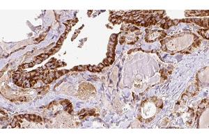 ABIN6267196 at 1/100 staining Human thyroid cancer tissue by IHC-P. (TPT1 antibody  (pSer46))