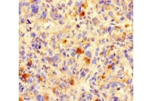 Immunohistochemistry of paraffin-embedded human melanoma using ABIN7161076 at dilution of 1:100 (B7-H6 antibody  (AA 25-262))