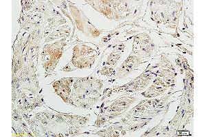 Formalin-fixed and paraffin embedded human colon carcinoma labeled with Anti-P2RX3/ATP receptor Polyclonal Antibody, Unconjugated (ABIN705866) at 1:200 followed by conjugation to the secondary antibody and DAB staining. (P2RX3 antibody  (AA 241-340))